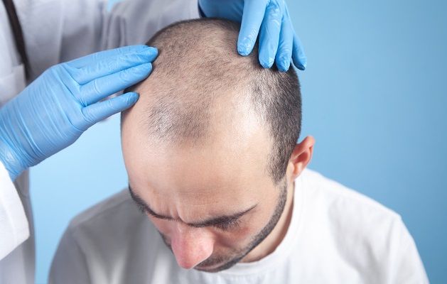 FUE hair transplant