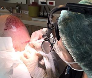 DHI hair transplant