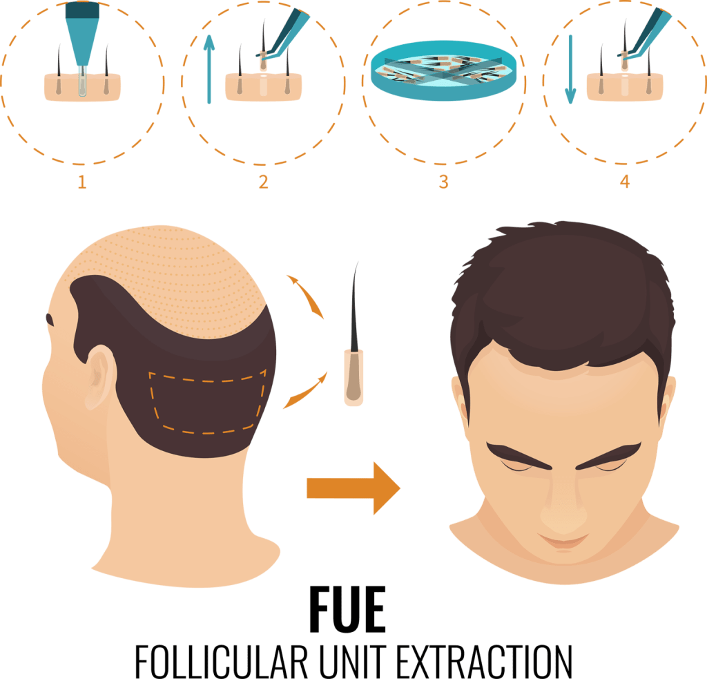 FUE hair transplant Capital Restoration