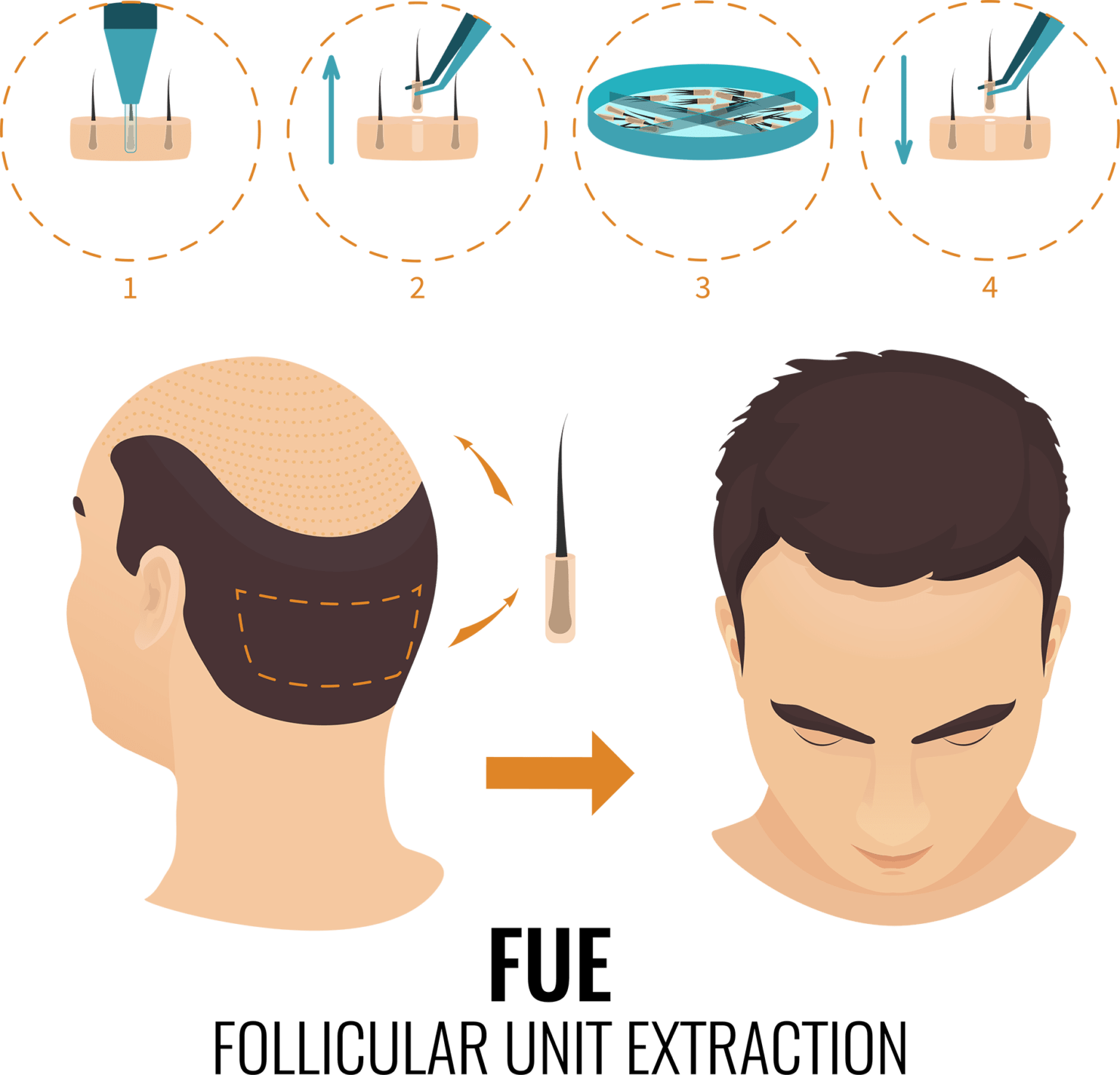 FUE hair transplant Capital Restoration