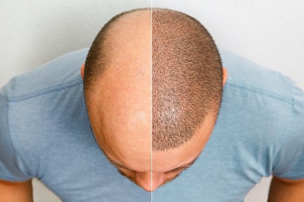 The head of a balding man before and after hair transplant surgery