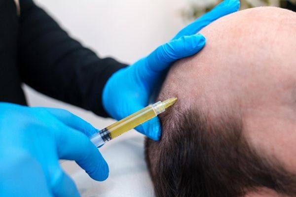 PRP treatment in men with alopecia