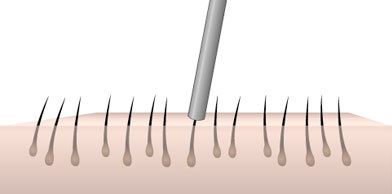 Technique and procedure hair transplant