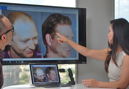 Hair transplant procedure with Bosley