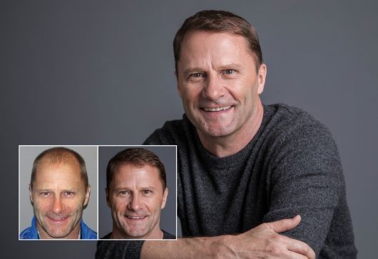 Hair restoration in Seattle with Bosley