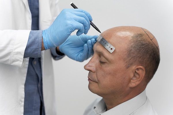 Best Hair Transplant in Cardiff