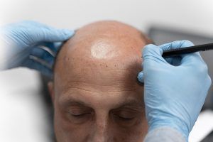 Best Hair Transplant Clinics And Doctors in Glasgow