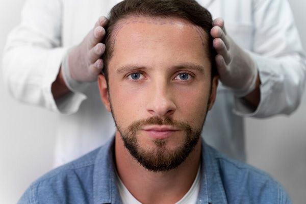 Scalp micropigmentation