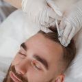 What is Hair Bioplasty?
