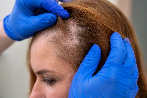 Hair Transplant on the Forehead for Women