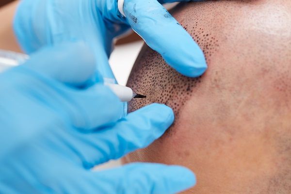 The Features of the Shaving Effects of Tricopigmentation