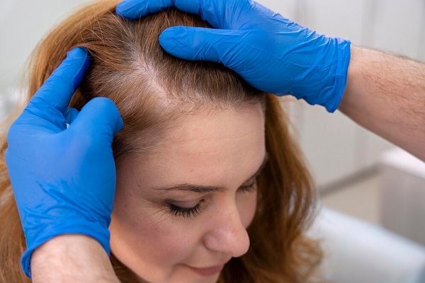 Hair transplant on the forehead for women