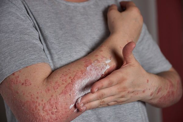 Applying moisturizer to skin with psoriasis