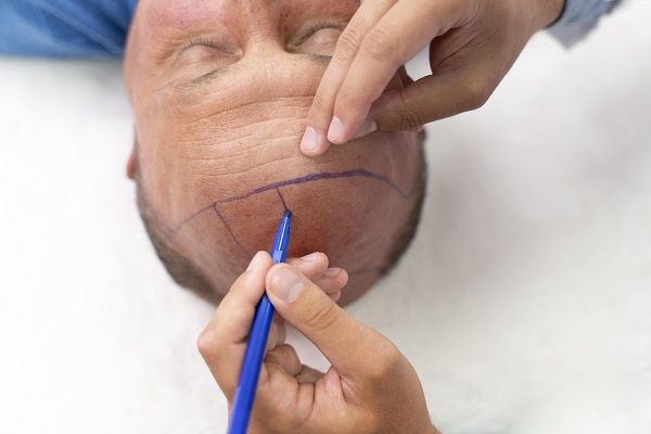 Best Hair Transplant Clinics and Doctors in Spain