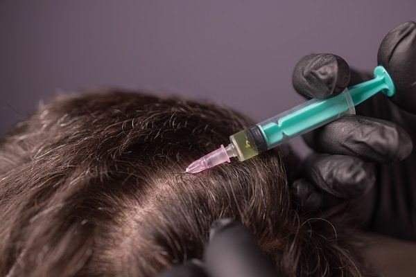 PRP treatment to stop premature balding