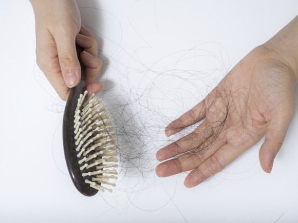 Treatment Options for Androgenic Alopecia in Young Women