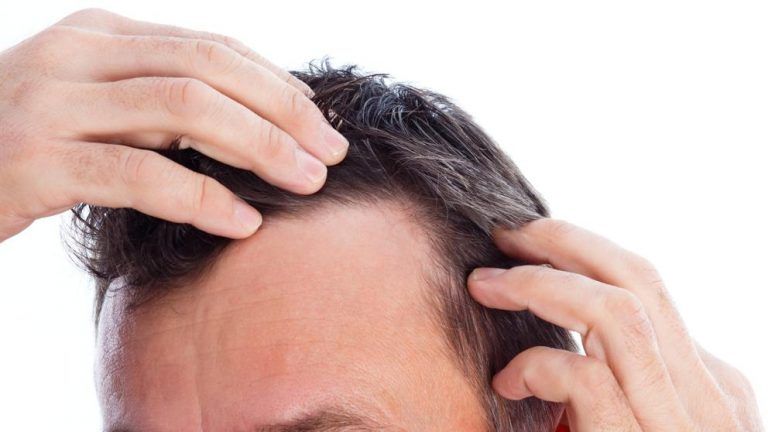 Recommendations after a hair transplant