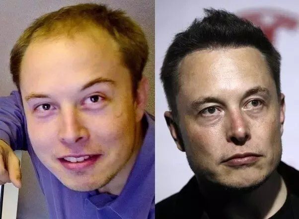 Elon Musk hair transplant