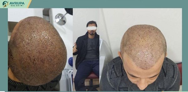 Avrupa hair transplant in Turkey