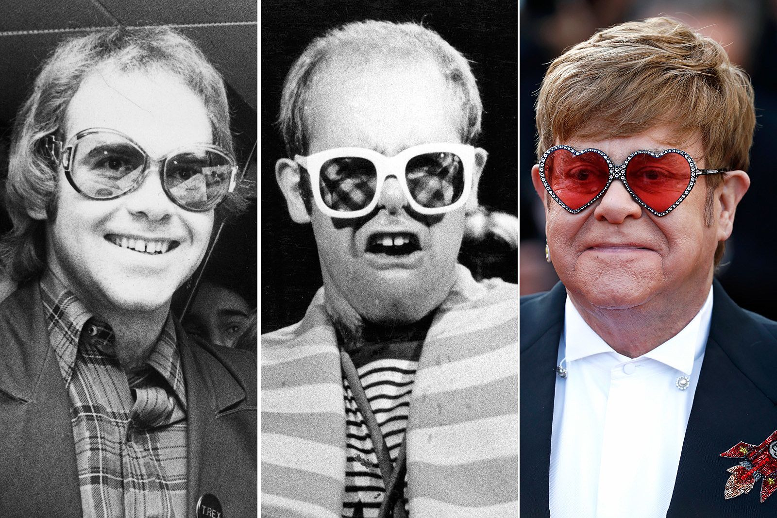 Elton John Hair transplant
