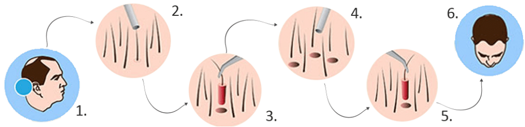 FUE hair transplant procedure