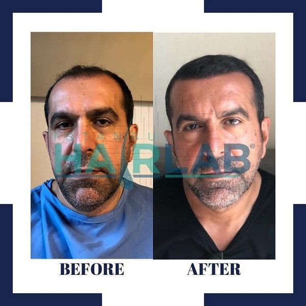 Hair transplant with Anatolia clinic, before and after photos