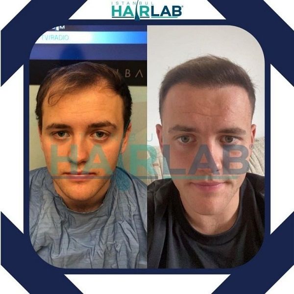 Before and after photos hair transplant Anatolia Clinic
