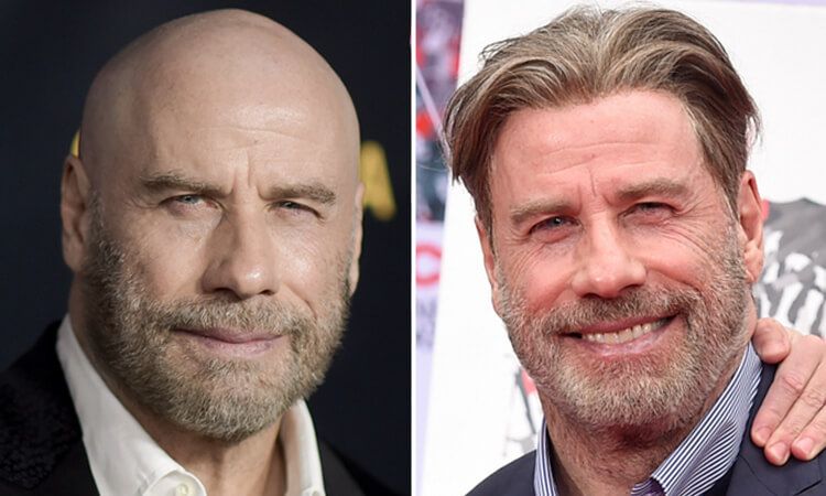 John Travolta hair transplant