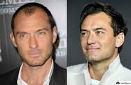 Jude Law hair transplant