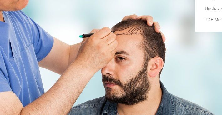 Mondes clinic FUE technique