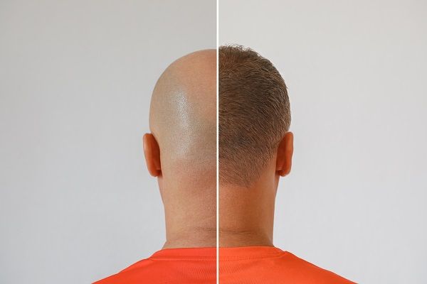 Can A Hair Graft Be Repaired?
