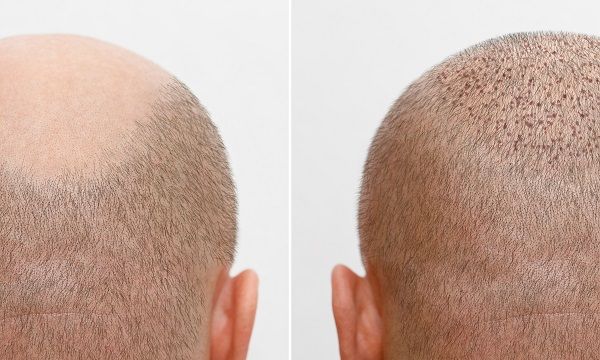 Hair transplant repaired