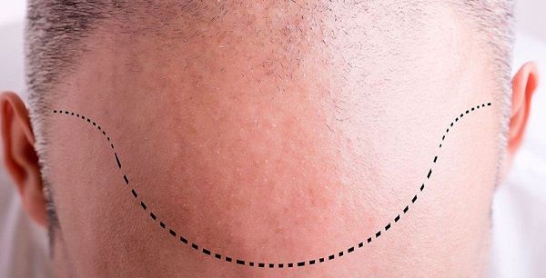 DHI HAIR TRANSPLANTATION TECHNIQUE WITH MONDES