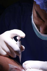 Doctor using choi pen in DHI hair transplant