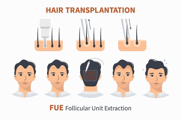 Body Hair Transplant