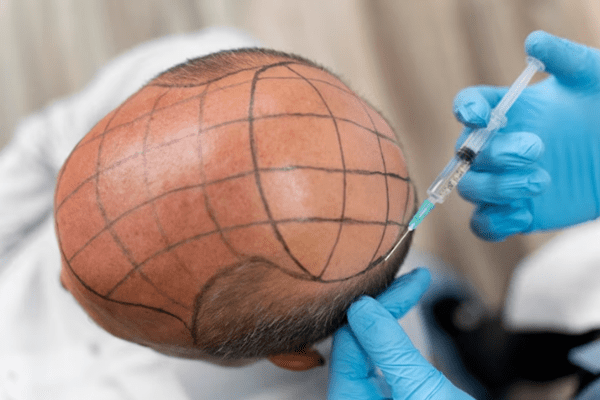 Scalp After a Hair Transplant