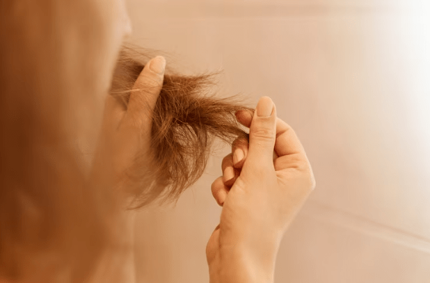 Folliculitis Decalvans