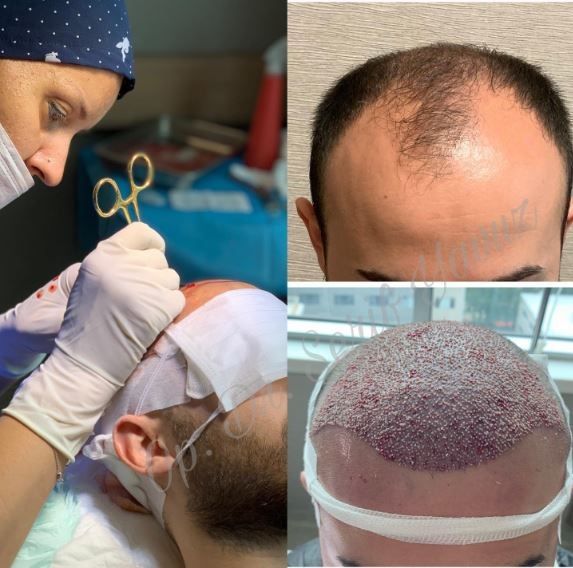 FUE hair transplant procedure with Dr. Serif Yavuz