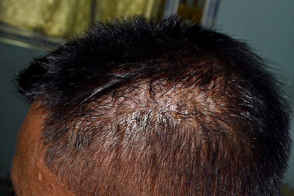 Seborrheic dermatitis at the scalp of adult male patient. lateral view.