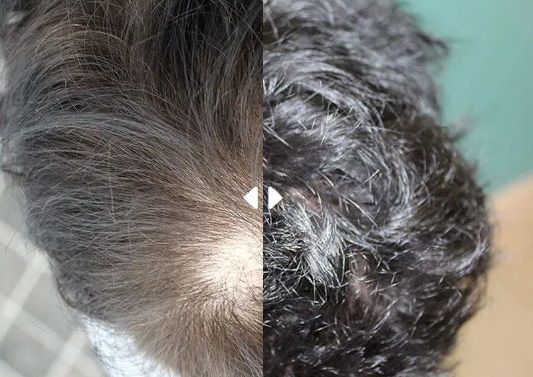 Tajmeel Clinic FUE method before-after
