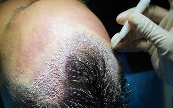 DHI Hair Transplant Technique