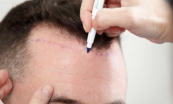 Fue Hair Transplant Technique