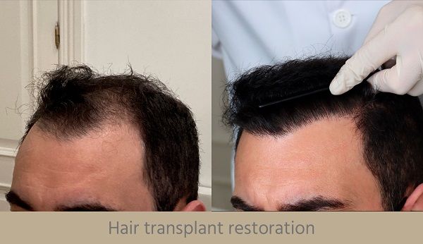 Hair restoration with Dr. Espinosa Custodio