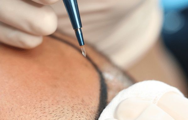 Sapphire Hair Transplant Technique