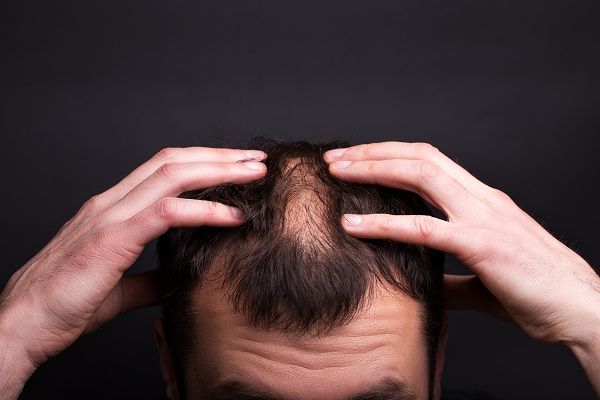 How to stop alopecia areata from spreading