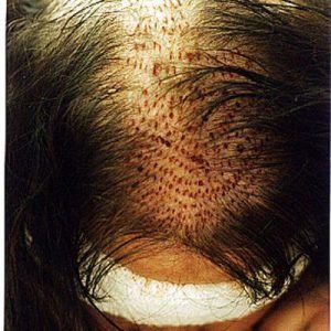 Immediately after surgery