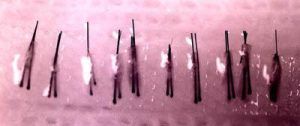 Hair follicular unit micrografts