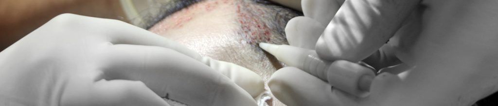 Pen implantes