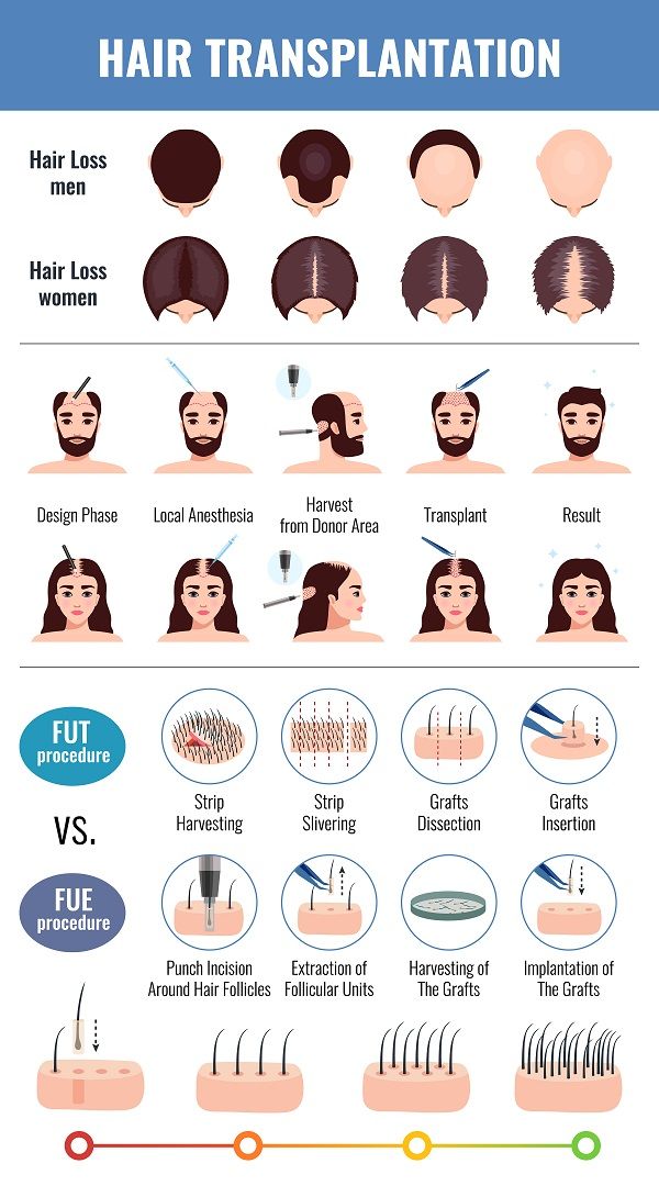 FUE vs. FUT hair transplant