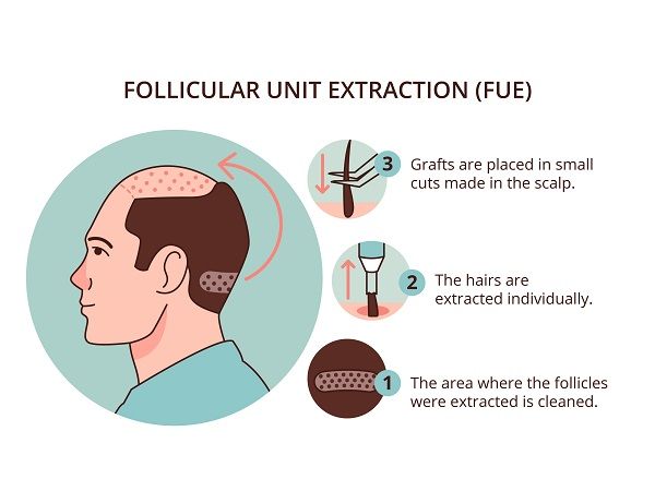 FUE hair transplant